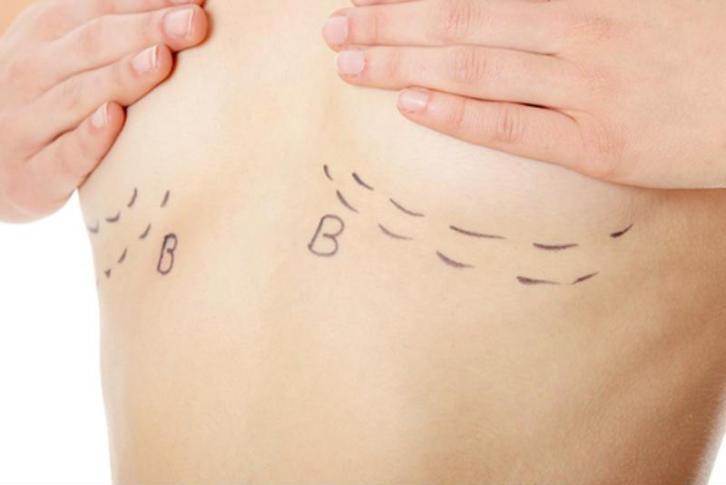 Breast procedures are common for a mommy makeover. 