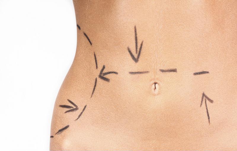 On average, a tummy tuck is more expensive than liposuction.