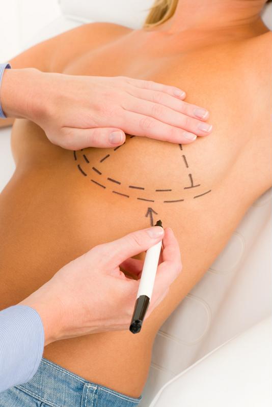 Doctor drawing surgery lines on a patient's breast.