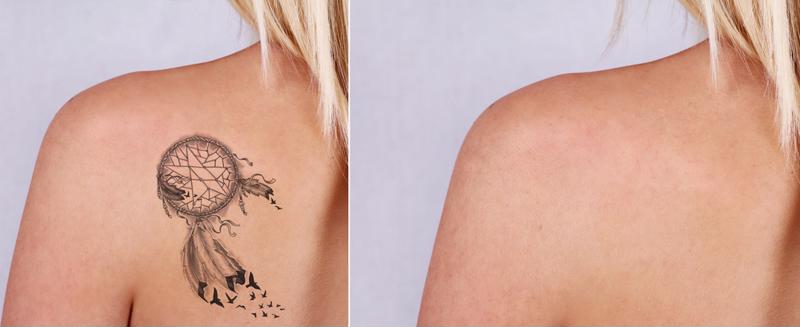 If you regret your tattoo, getting it removed can help you get a fresh start for your skin.